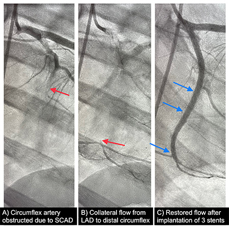 Orlando’s angiograms, before and after cardiac catheterization